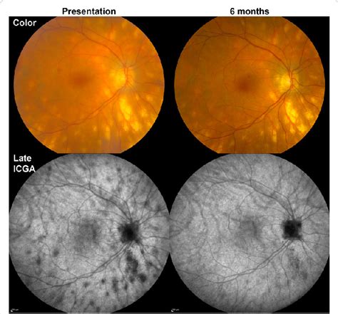 versace birdshot|Birdshot chorioretinopathy .